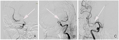 Predictors of First-Pass Effect in Endovascular Thrombectomy With Stent-Retriever Devices for Acute Large Vessel Occlusion Stroke